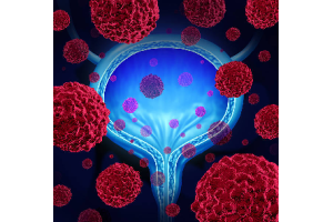 Cancer de la vessie et fuites urinaires : comprendre les liens et les solutions