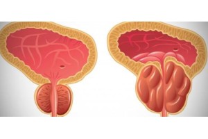 Enlarged Prostate in Men: Causes, Symptoms and Treatment Options